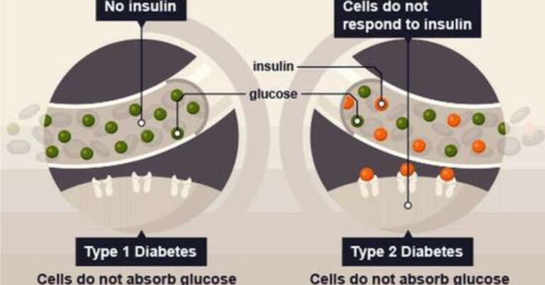 Revolutionizing Type 2 Diabetes Treatment: Stem Cell Therapy in India